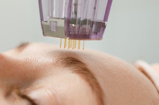 Microneedling handpiece in close-up